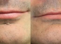 ✨Biancat® 2-in-1 Microneedle & Hydrocolloid Patch🍀| Removes Raised Moles, Acne, Flat Warts & Skin Tags | Helps Improve Wrinkles, Scars & Blemishes | Invisible Patches for Face & Body