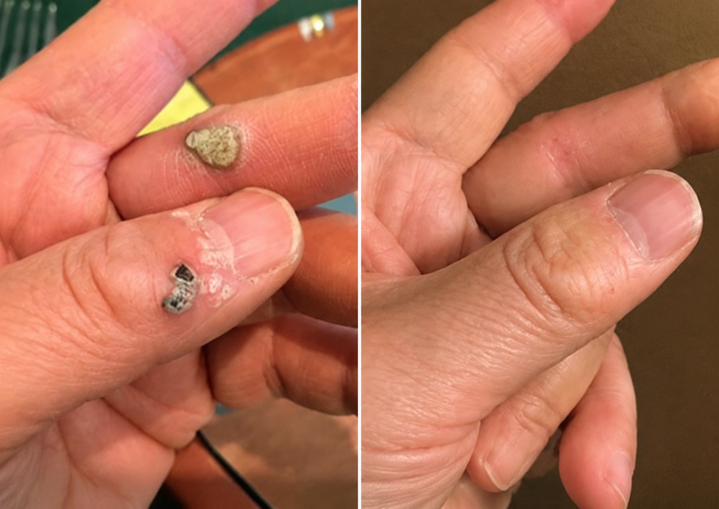 ✨Biancat® 2-in-1 Microneedle & Hydrocolloid Patch🍀| Removes Raised Moles, Acne, Flat Warts & Skin Tags | Helps Improve Wrinkles, Scars & Blemishes | Invisible Patches for Face & Body